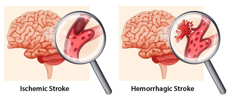 illustration of ischemic vs hemorrhagic stroke on right side of brain