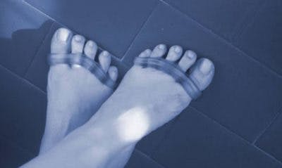 How to Fix Curled Toes: 6 Treatment 