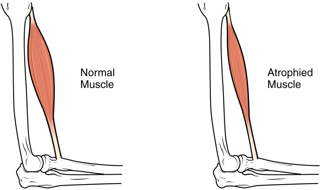 muscle atrophy due to spinal cord injury