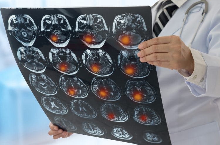 neurólogo con escáner cerebral que muestra diferentes tipos de acv