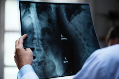x-rays of spinal cord injury in children