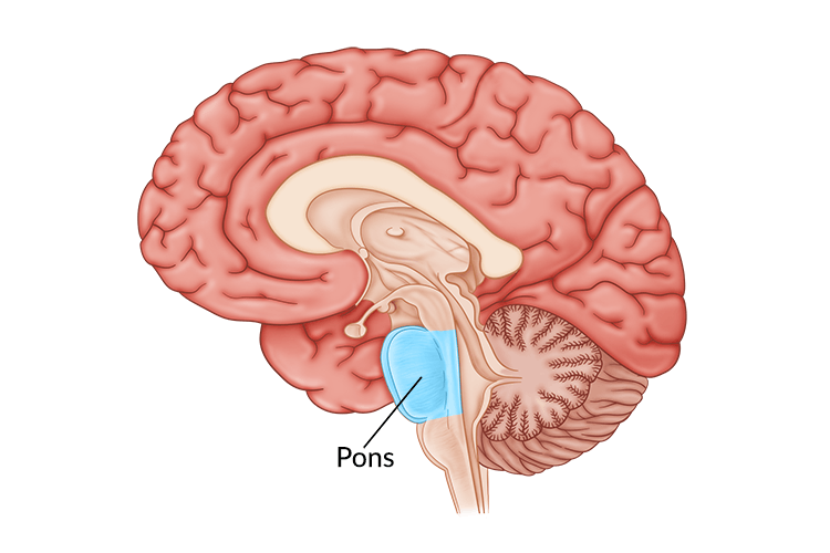 medical illustration of brain with pons highlighted within the brain stem to illustrate the location of a pontine stroke