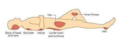 pressure sore sci complications