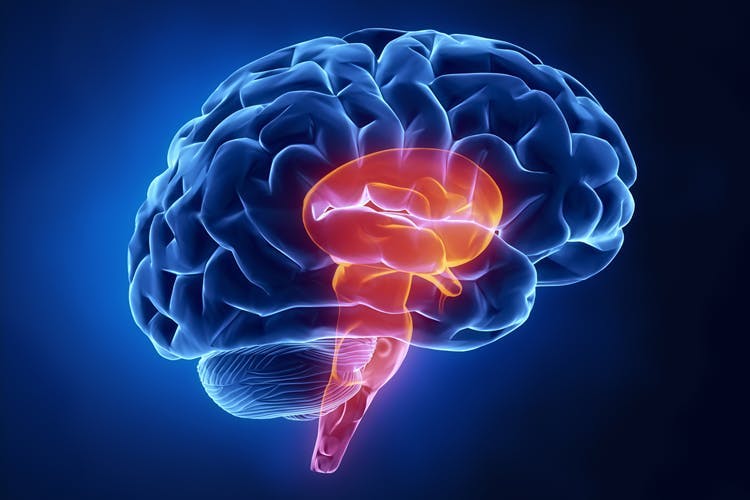 Imagen de un accidente cerebrovascular en el tronco del cerebro