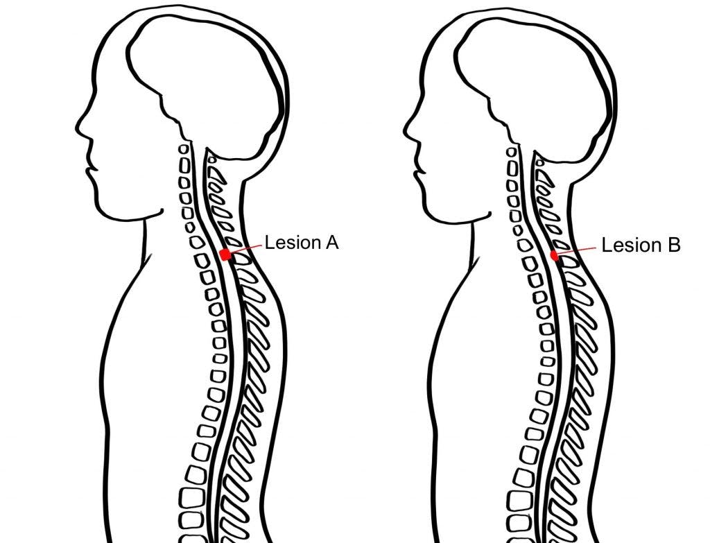 quadriplegic recovery factors