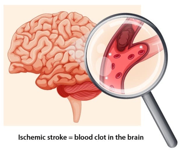 Aspirin for Emergency Stroke Treatment: When Can It Be Safely Used ...