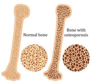 osteoporosis vs normal bone mineral density