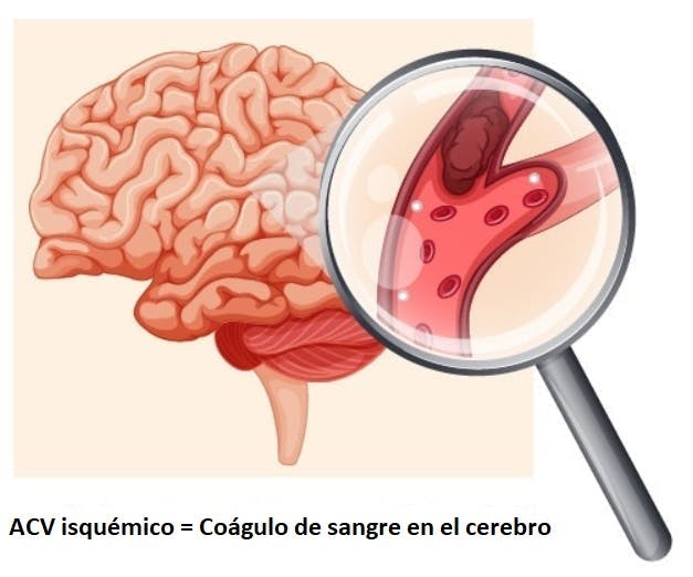 coágulo de sangre en el cerebro