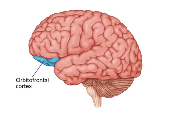 medical illustration of brain highlighting orbitofrontal cortex damage