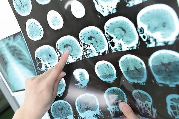 Doctor pointing at mri image of hypothalamus brain injury