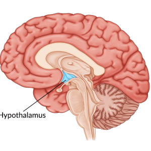 medical illustration of hypothalamus damage