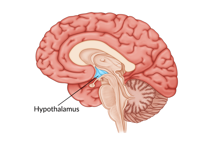 medical illustration of hypothalamus damage