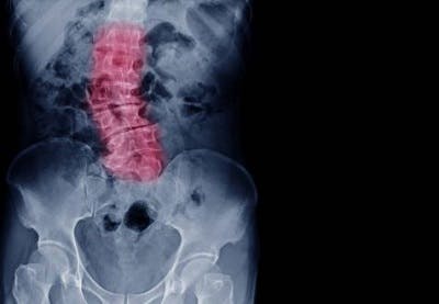 xray of scoliosis in spinal cord injury patient