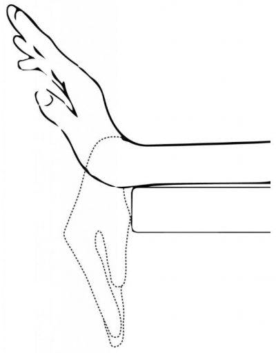 Hand injury exercise 9: Passive finger hook fist 