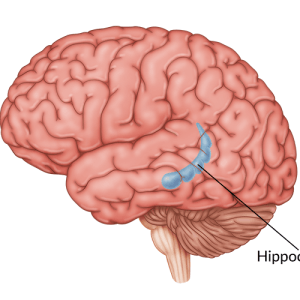 medical illustration of hippocampus damage after a brain injury