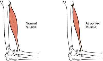 t12 spinal cord injury muscle atrophy