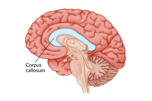 medical illustration of brain highlighting corpus callosum damage