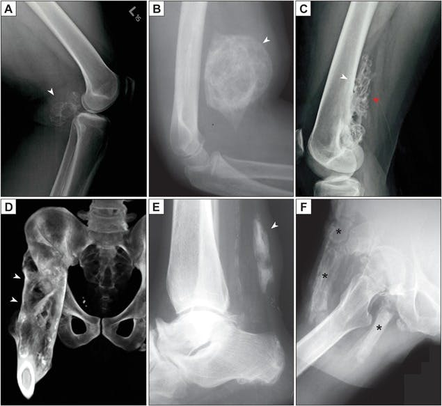 heterotopic ossification spinal cord injury radiographs