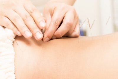 Akupunkteur, der Nadeln auf Patienten mit massivem Schlaganfall anwendet