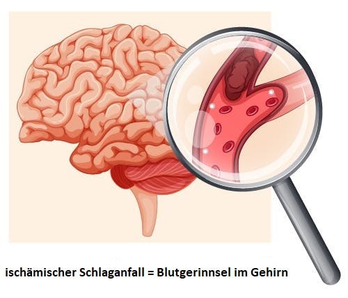 Mini-Schlaganfall-Wiederherstellungsanleitung