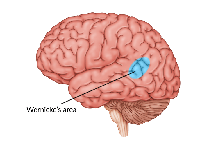 medical illustration of brain with wernicke's area damage highlighted in center