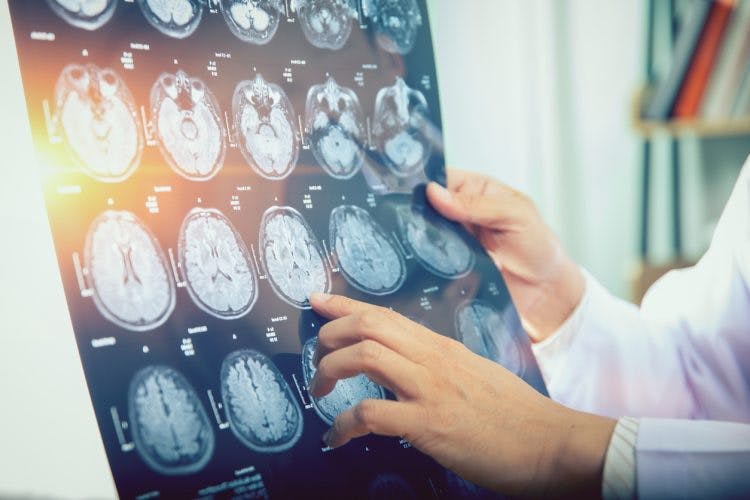 Arzt zeigt Gehirn-Scan des bilateralen Schlaganfalls