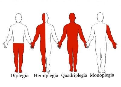 diagram showing different types of spastic cp