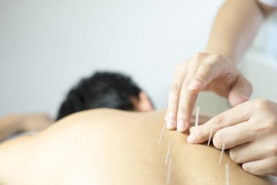 Akupunkteur behandelt Schlaganfallpatienten mit Erbrechen und Übelkeit