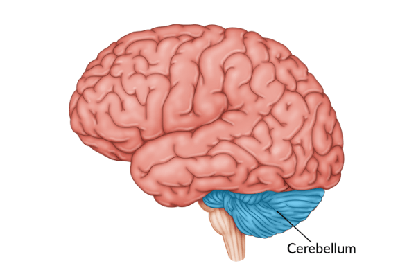 medical illustration of brain highlighting cerebellum damage