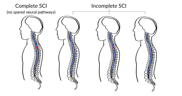 Incomplete Quadriplegia: Frequently Asked Questions | Flint Rehab