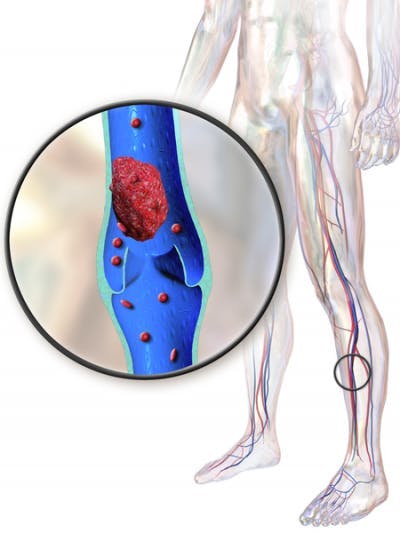 deep vein thrombosis blood clotting due to reduce mobility