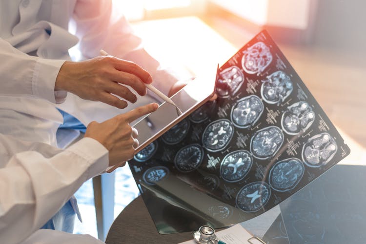 doctors looking at MRI that shows signs of mixed transcortical aphasia