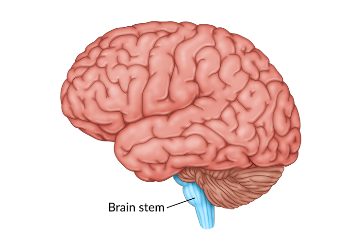 medical illustration of brain highlighting the brain stem damage