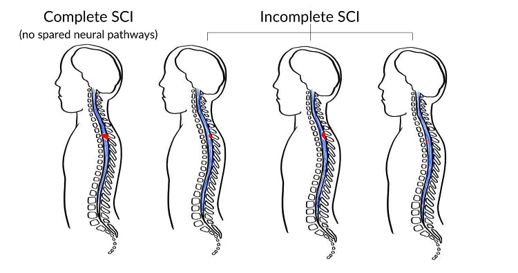 complete v incomplete spinal cord injury