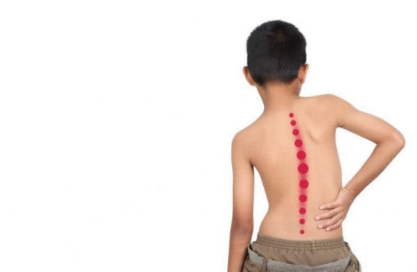why children with cerebral palsy develop scoliosis