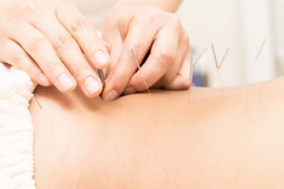 acupuncture: alternative au traitement de récupération après un AVC