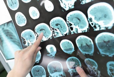 chirurgie de traitement de l'AVC