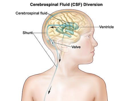 how to treat hydrocephalus in cerebral palsy patients