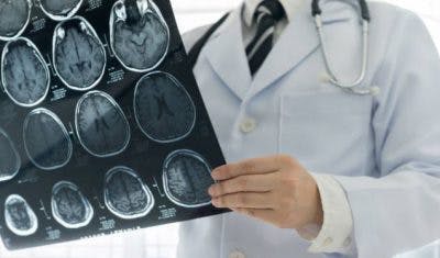 doctor holding brain scans of stroke patient
