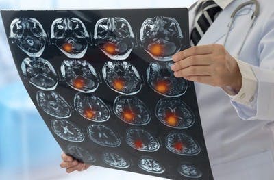Un médecin tient à main l'IRM du cerveau d'un patient pour apprécier les premières étapes du traitement.