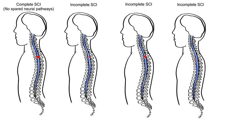 complete v incomplete spinal cord injury statistics