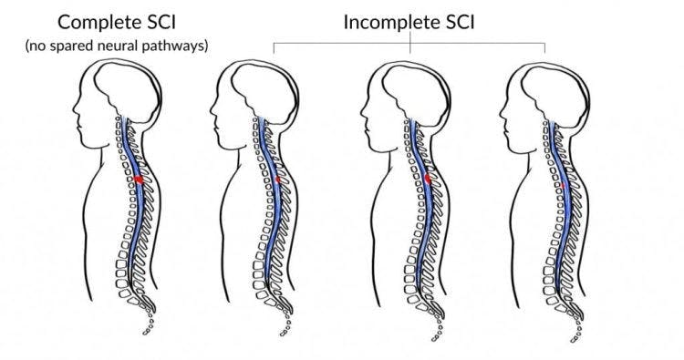 illustration of complete spinal cord injury lesion vs incomplete spinal cord injury lesion