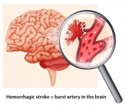 illustration de l'artère dans le cerveau éclatant hémorragie intracérébrale