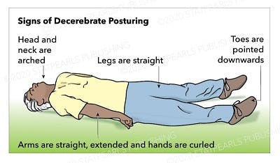 illustration of abnormal posturing after brain injury