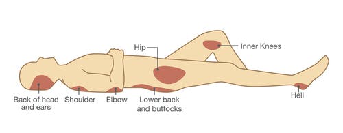 illustration of common pressure ulcer locations: back of head, shoulder, elbow, hip, inner knee, and heel