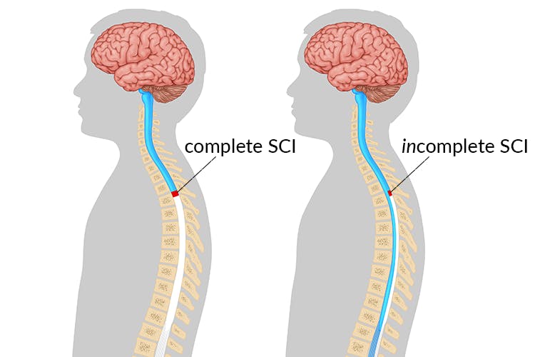 complete vs incomplete quadriplegia