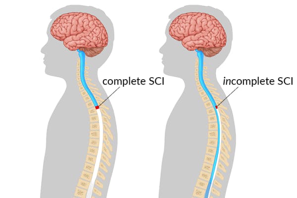 illustration showing the difference between a complete and incomplete spinal cord injury