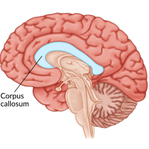 illustration of area affected by corpus callosum stroke