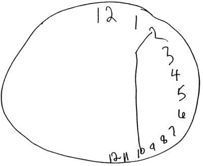 a stroke survivor with left visual neglect was asked to draw in the letters on a clock, and the illustration shows all 12 numbers squeezed into the right side of the clock
