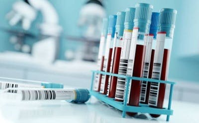 blood testing samples to help diagnose a stroke